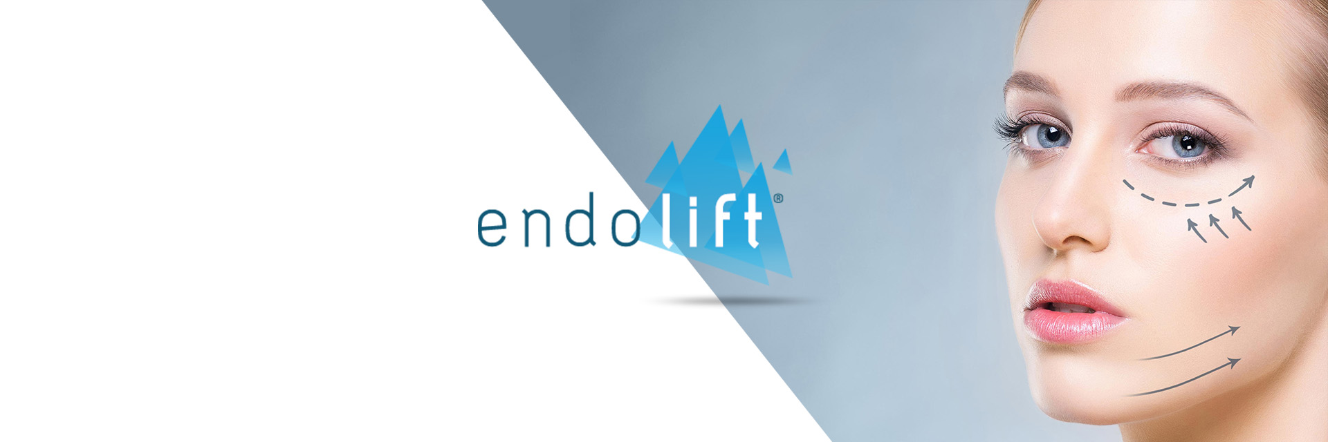 EndoLift